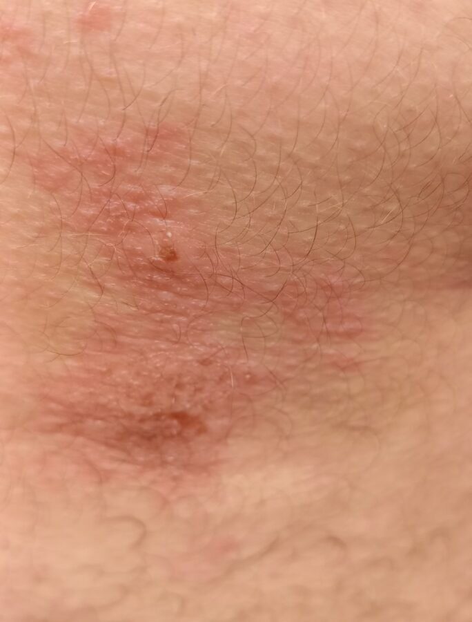 После поездки в автобусе под Тверью у молодого человека появился ожог