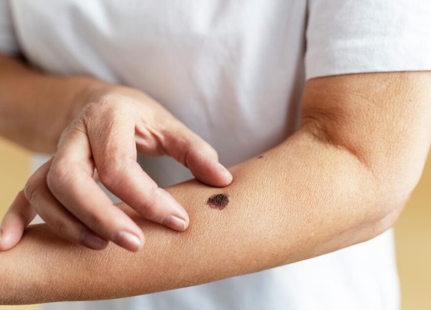 Врач рассказал об опасных и безопасных родинках