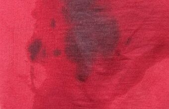 После поездки в автобусе под Тверью у молодого человека появился ожог