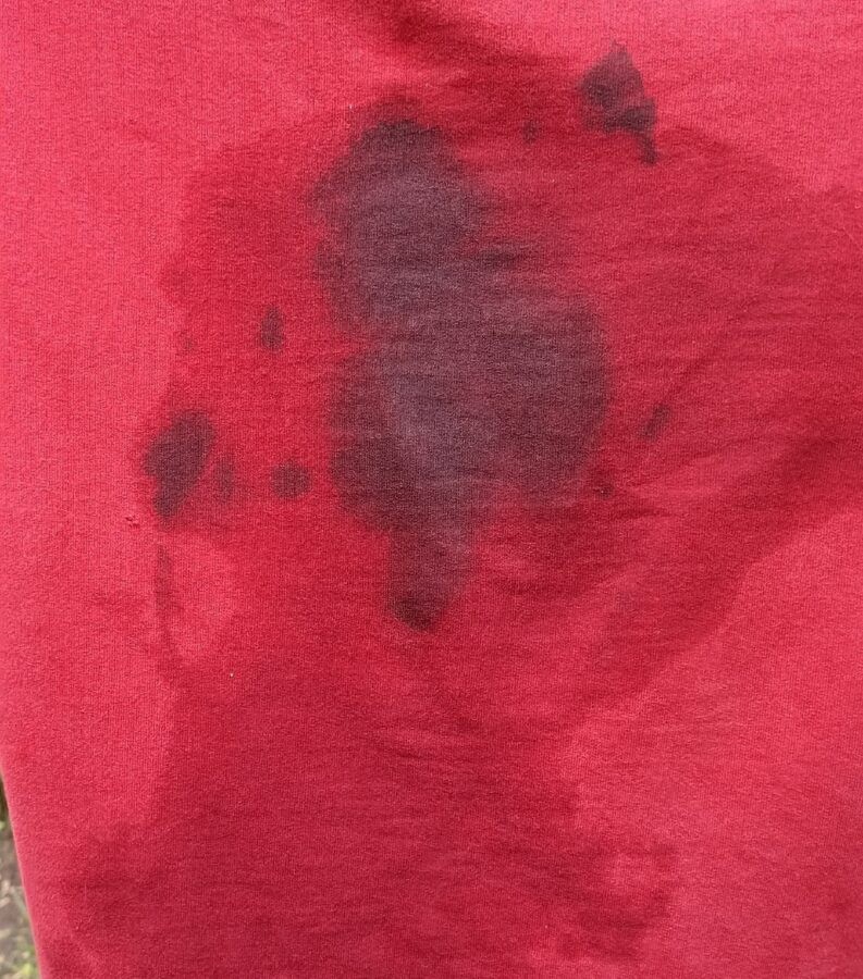 После поездки в автобусе под Тверью у молодого человека появился ожог