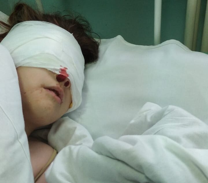 В Тверской области немецкая овчарка искусала лицо 10-летней девочке В Тверской области немецкая овчарка искусала лицо 10-летней девочке