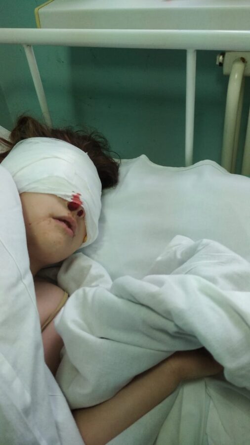 В Тверской области немецкая овчарка искусала лицо 10-летней девочке В Тверской области немецкая овчарка искусала лицо 10-летней девочке