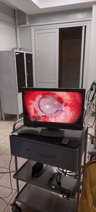 В Тверской области впервые провели сложную операцию на глазах В Тверской области впервые провели сложную операцию на глазах