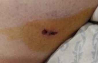 В Тверской области дикая собака покусала ребенка В Тверской области дикая собака покусала ребенка