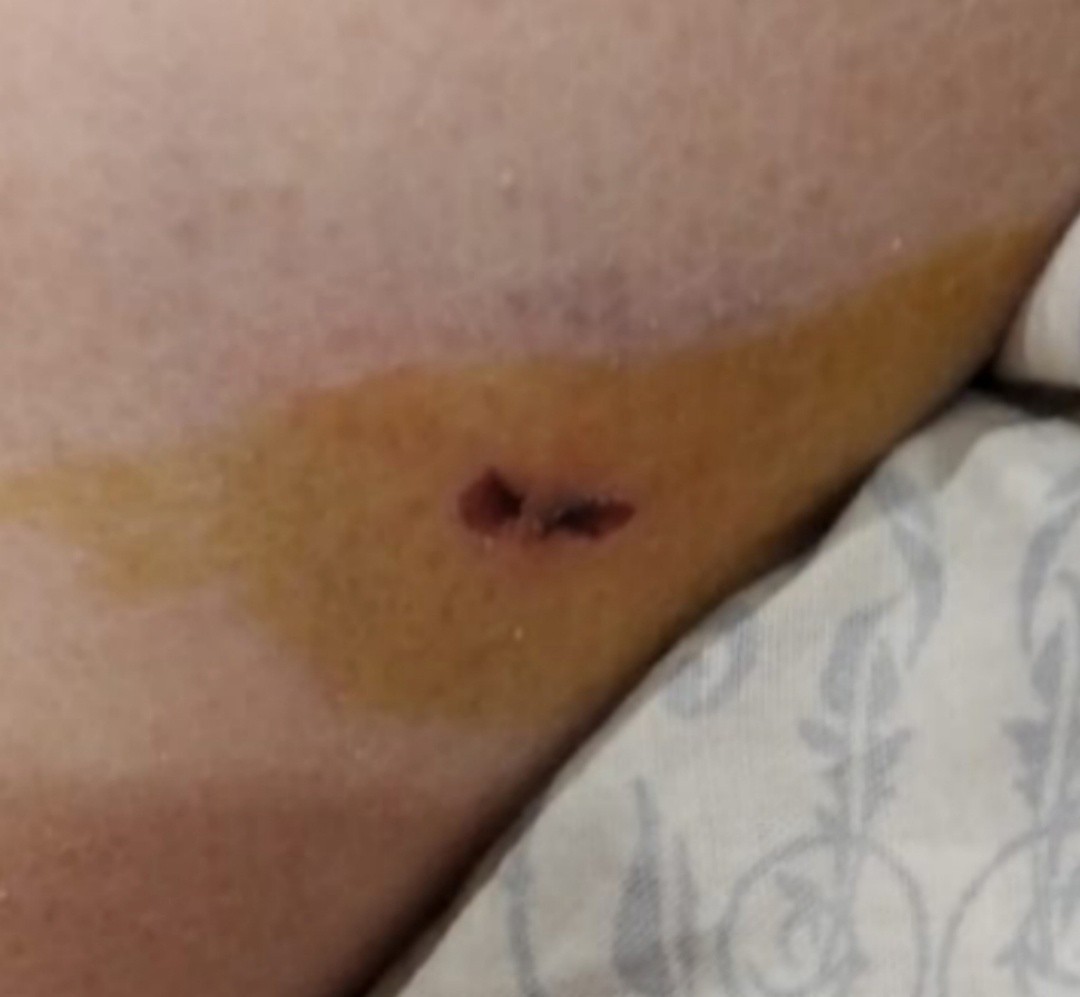 В Тверской области дикая собака покусала ребенка