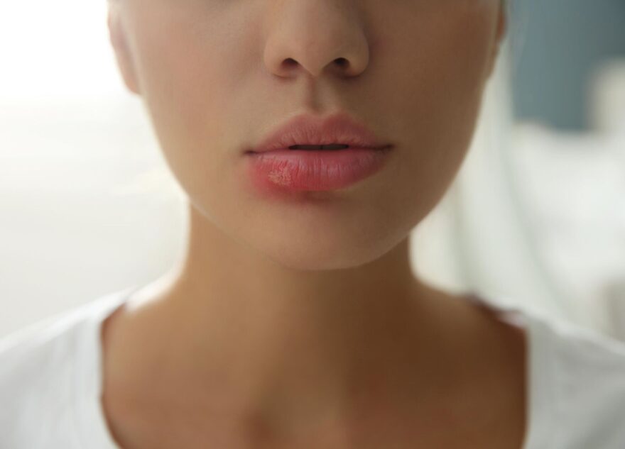 Врач рассказала о страшной опасности простого герпеса для жизни