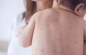 Врач рассказала о сыпи, сигнализирующей о серьезных заболеваниях Врач рассказала о сыпи, сигнализирующей о серьезных заболеваниях