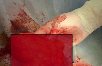 В Твери медики удалили у женщины огромную опухоль В Твери медики удалили у женщины огромную опухоль