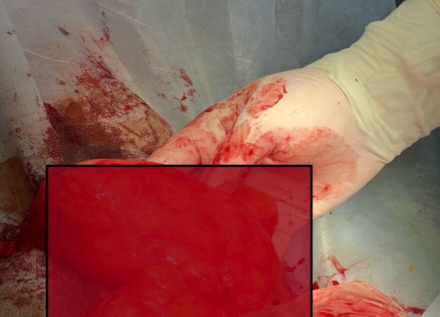 В Твери медики удалили у женщины огромную опухоль