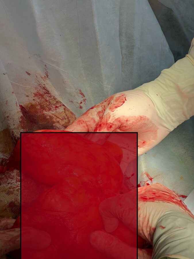 В Твери медики удалили у женщины огромную опухоль