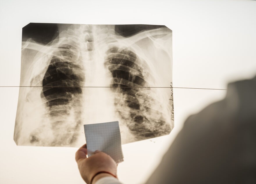 Опасный грипп летучих мышей может поражать легкие человека