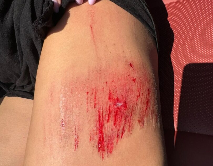 В Тверской области девушка упала в яму