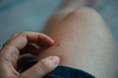 У россиян обнаружили опасное заболевание, передающееся через укус комаров