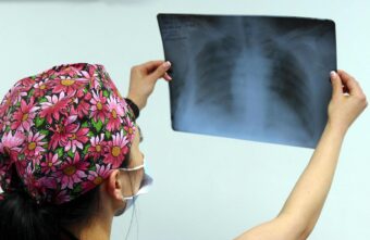 Врач рассказал о бессимптомном раке легких