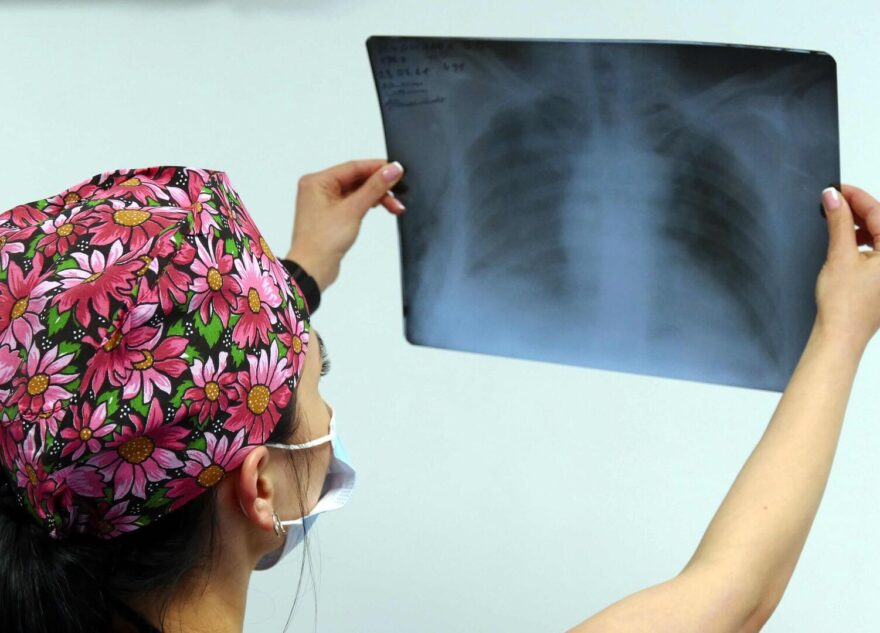 Врач рассказал о бессимптомном раке легких