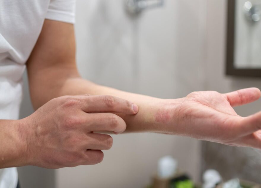 Травматолог дал советы первой помощи при различных ожогах