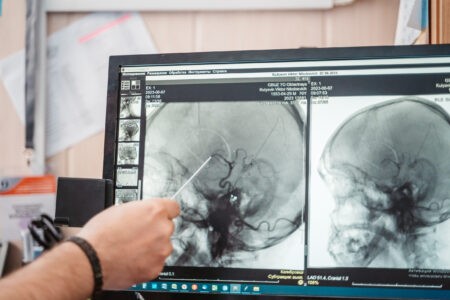 Врач назвал факторы риска развития инсульта Врач назвал факторы риска развития инсульта