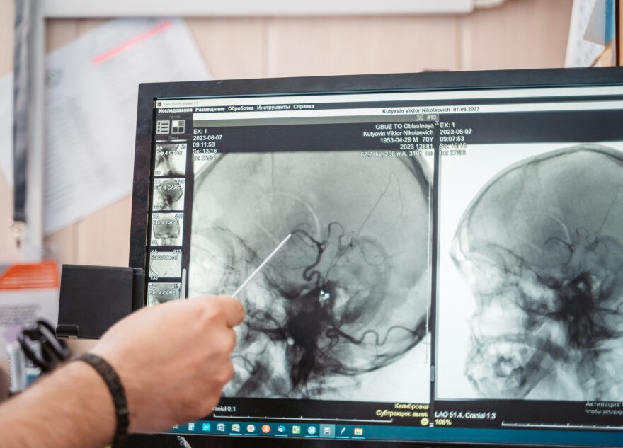 Врач назвал факторы риска развития инсульта