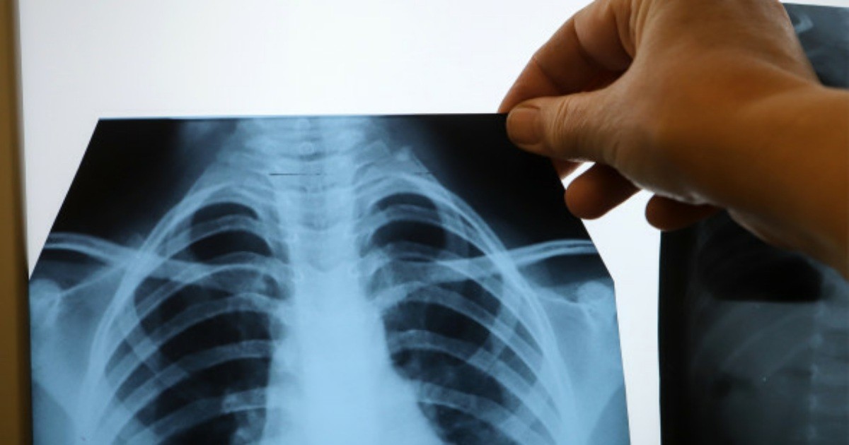 Врач рассказал об опасности рака легких из-за пассивного курения