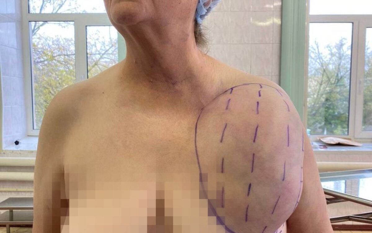 Тверские хирурги удалили у женщины опухоль, которая весила 4 килограмма  