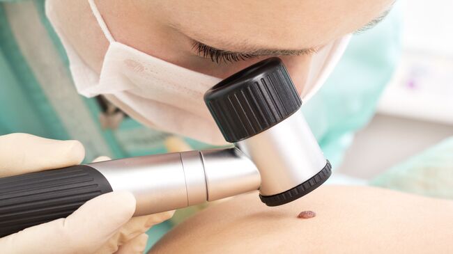 Врач рассказала, какие родинки могут вызвать рак