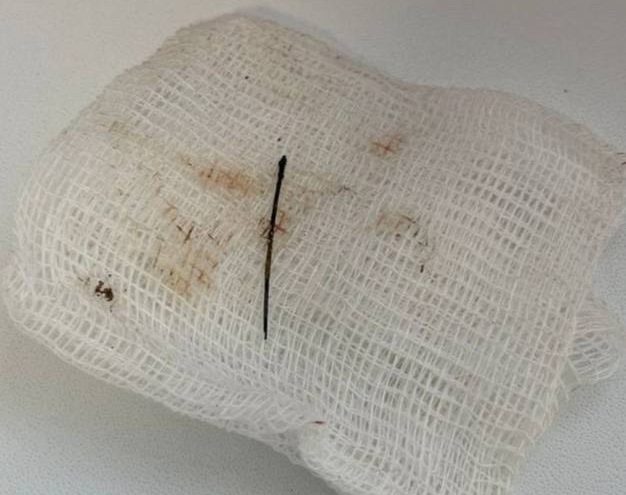 В Твери хирурги спасли пациентку с иглой в легком