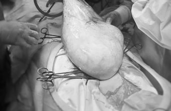 В Твери провели сложную операцию, удалив женщине огромную опухоль