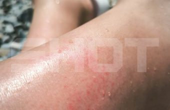 У российских туристов после купания на зарубежных курортах появляется страшная сыпь сыпь