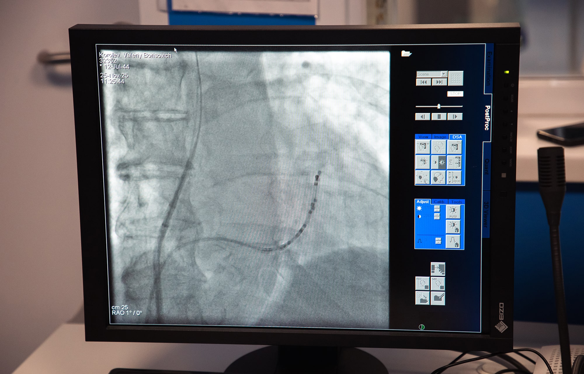 В Твери активно развивается высокотехнологичная помощь пациентам с мерцательной аритмией