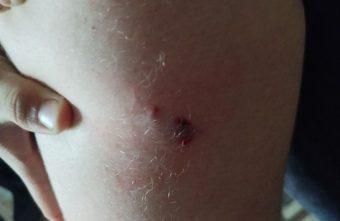 В Тверской области собака покусала ребенка В Тверской области собака покусала ребенка